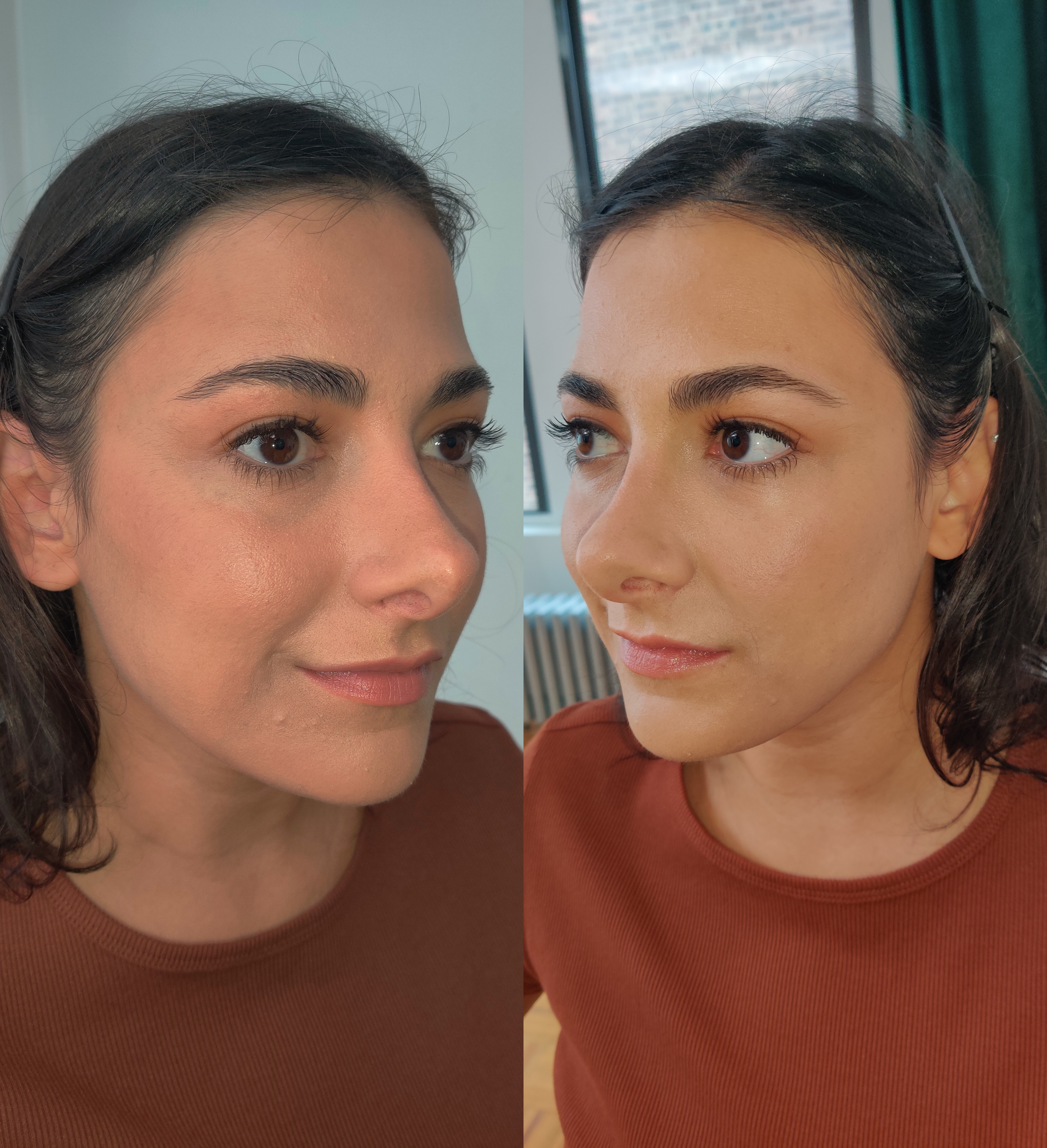 After (sides)