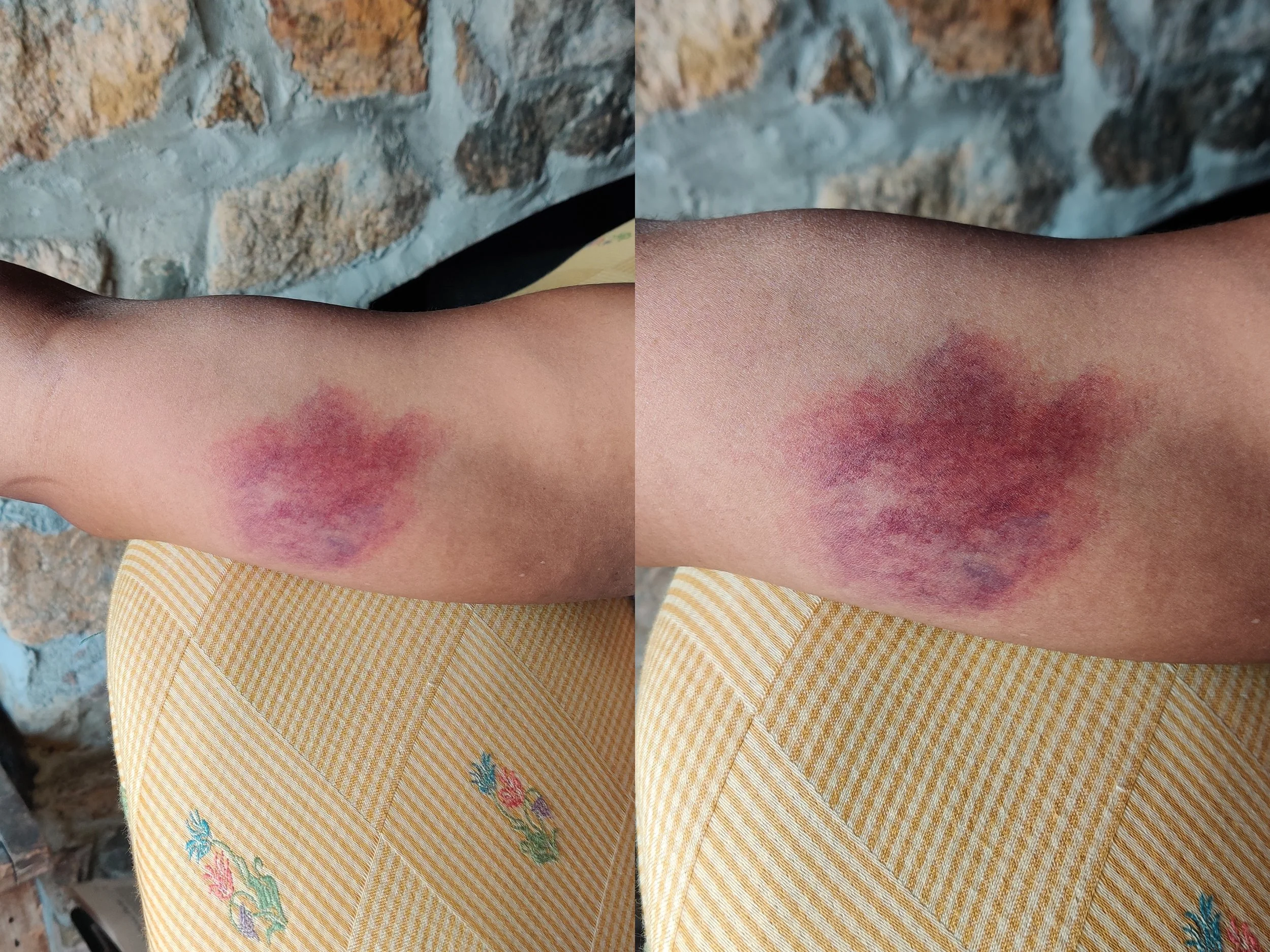 bruise created with Skin Illustrator paints