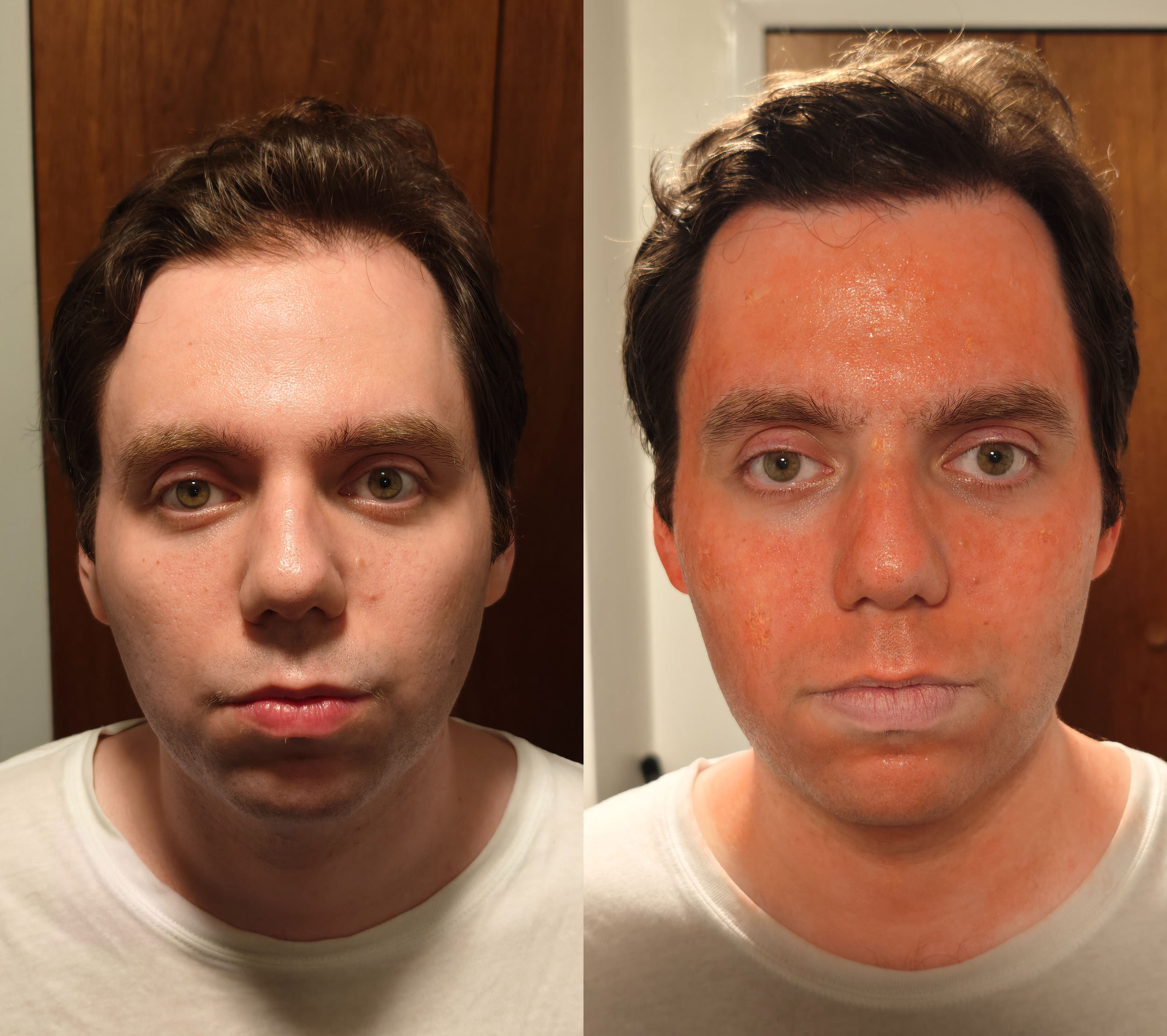 andy sunburn before and after.png