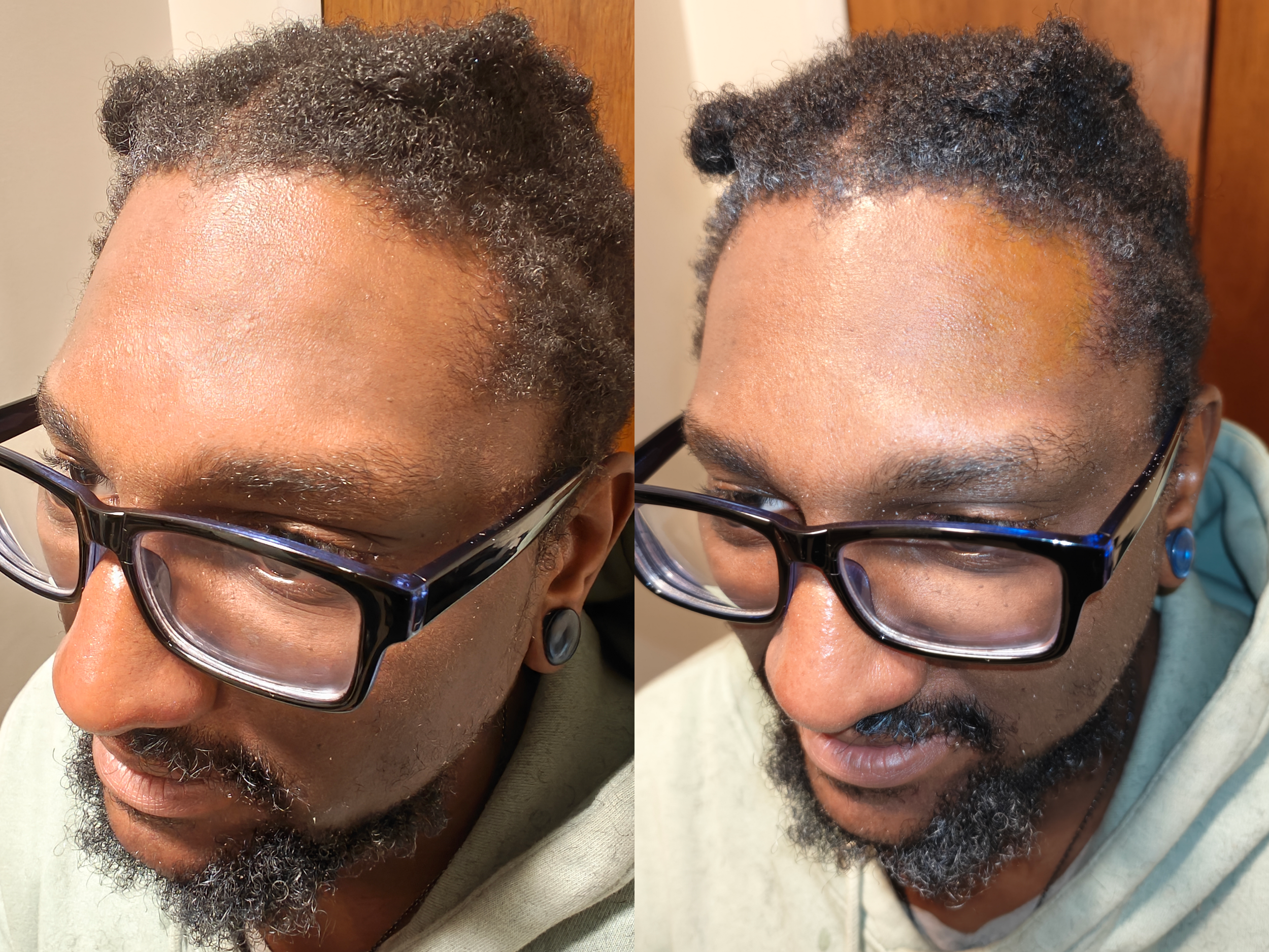 Healing Bruise on Dark Skin
