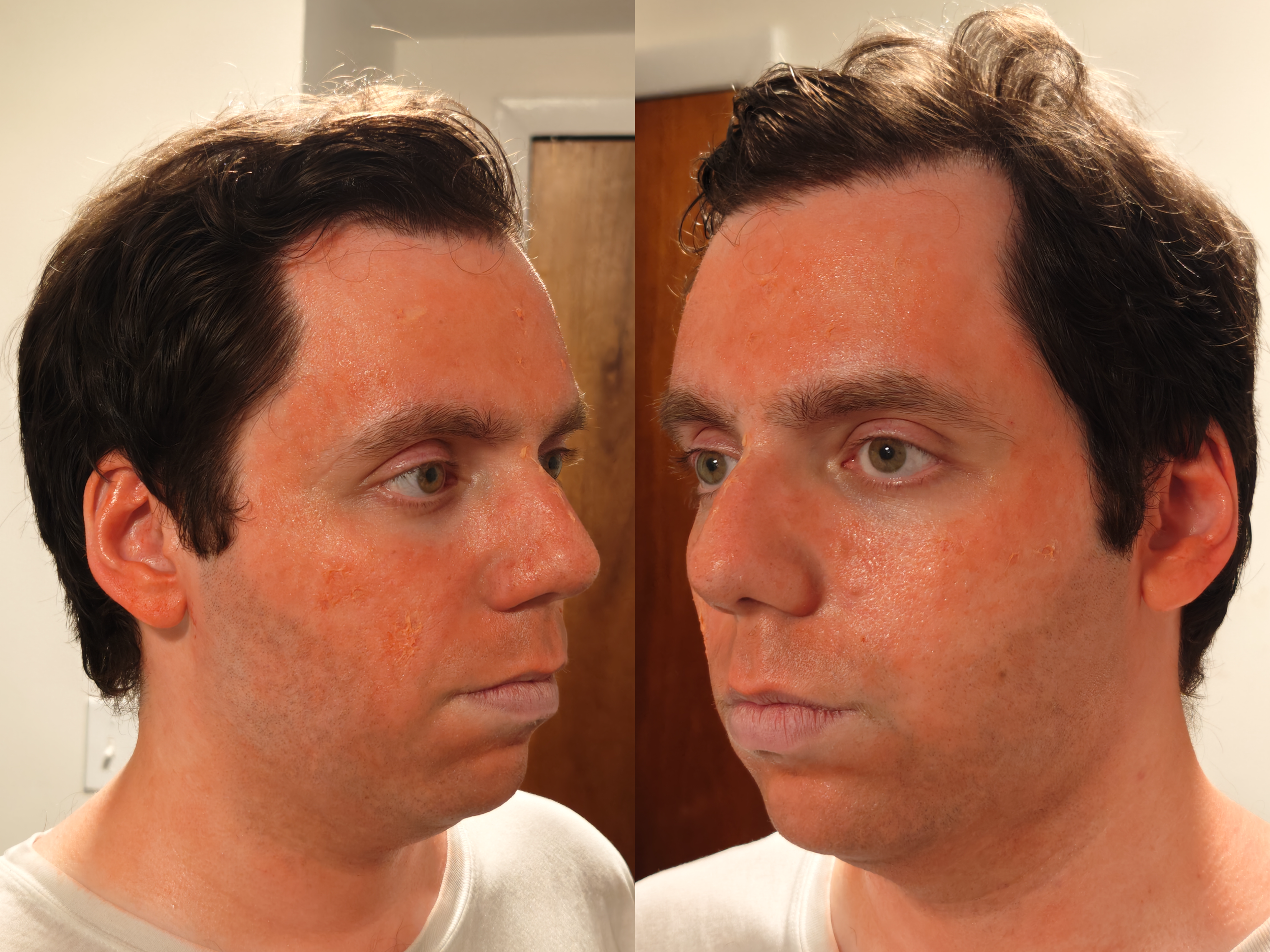 andy sunburn after sides.png