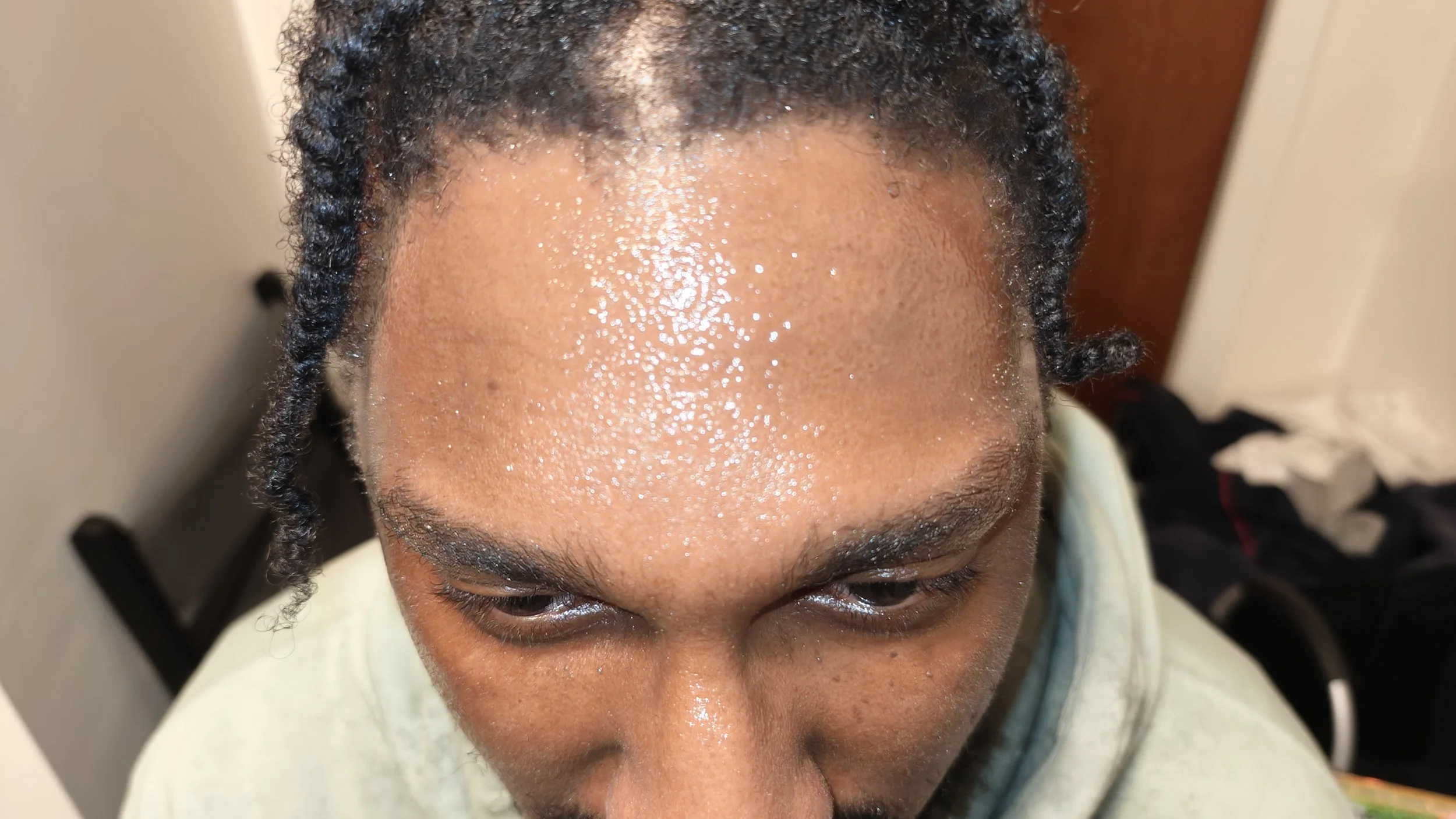 After (alternate view, forehead)