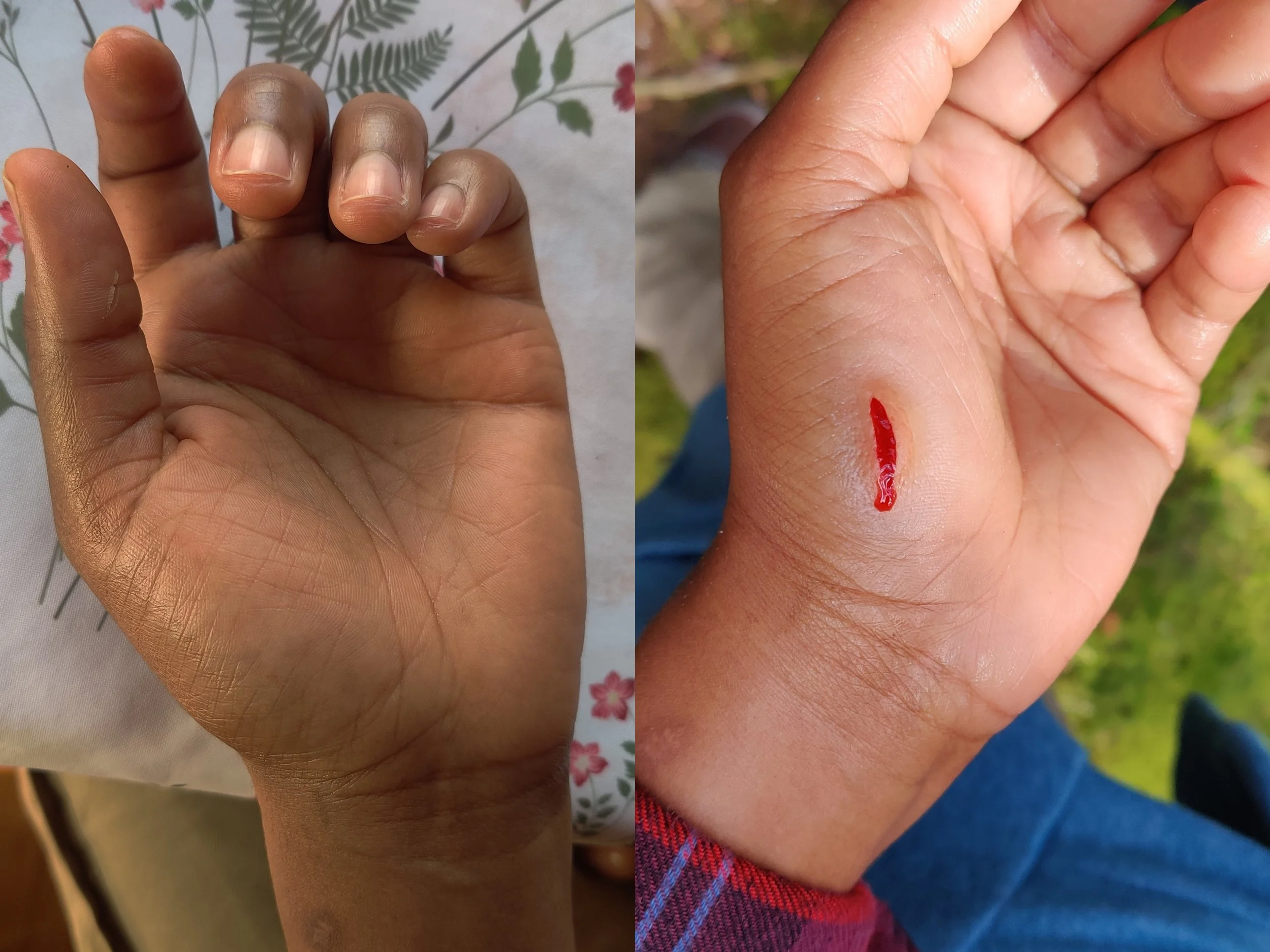 Small cut prosthetic transfer application; Before (left), After (right)