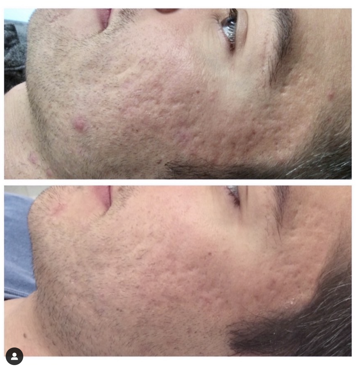 Microneedling