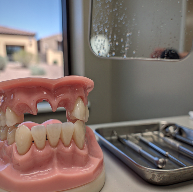 Dental Bridge vs. Implant: What Decides It for One Missing Tooth