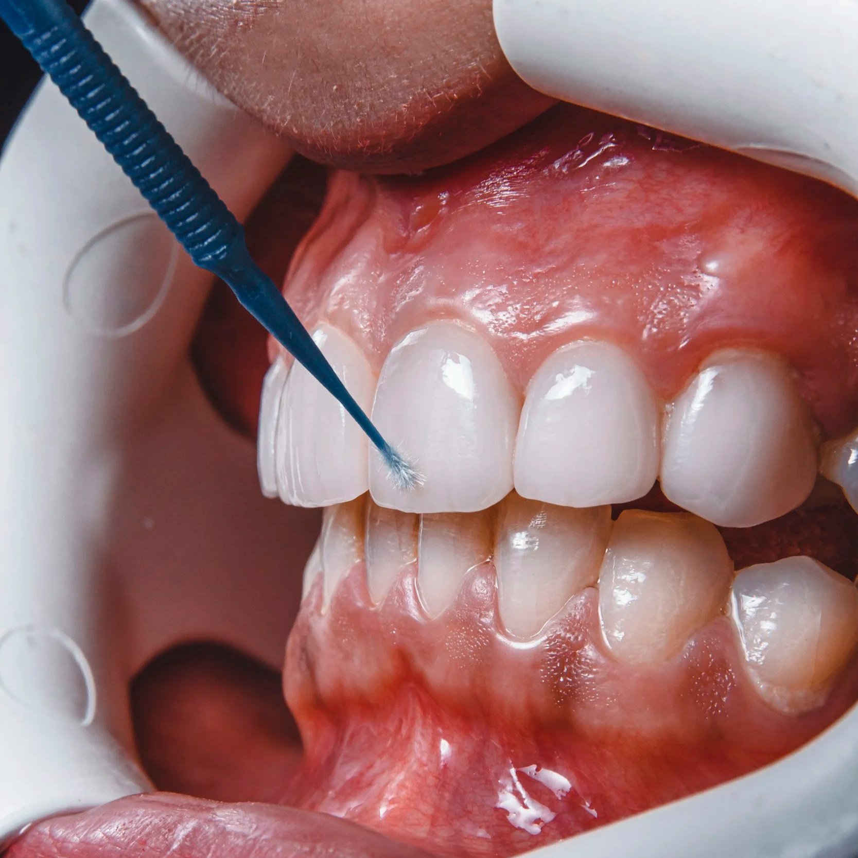 Gum Disease Will Steal a Smile: Maintain with Periodontal Check-Ups