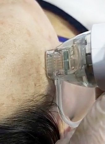 dermaforce treatment.jpeg