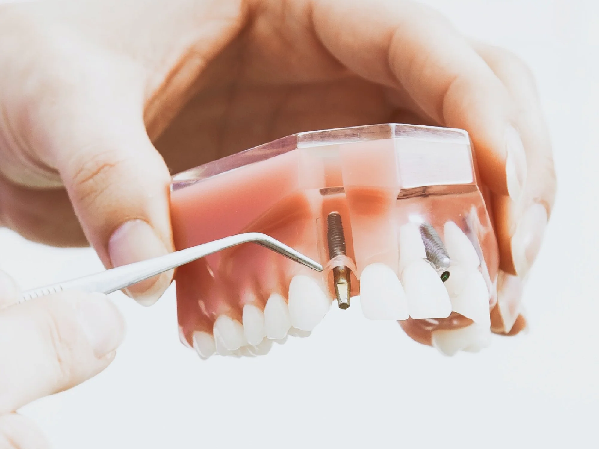 Dental Implant Services Charlotte NC Implant Restorations Charlotte