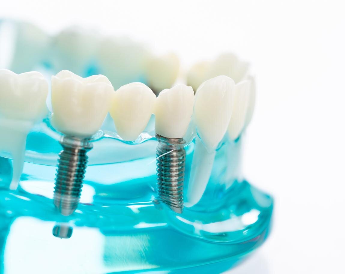 Dental Implants Albany Ny