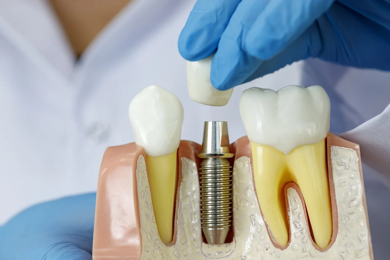 Steps in Getting Dental Implants