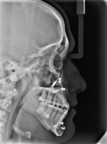 Lateral X-ray of a person's skull showing facial bones, jaw, and teeth.