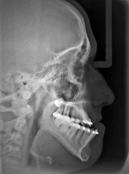 Lateral X-ray of a human skull showing teeth and jaw structure.
