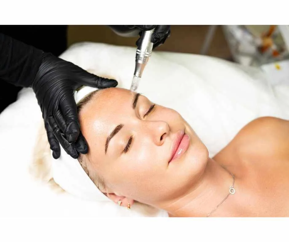 Microneedling for Acne and Acne Scars: How Collagen Remodeling Improves Skin Texture and Reduces Scar Depth