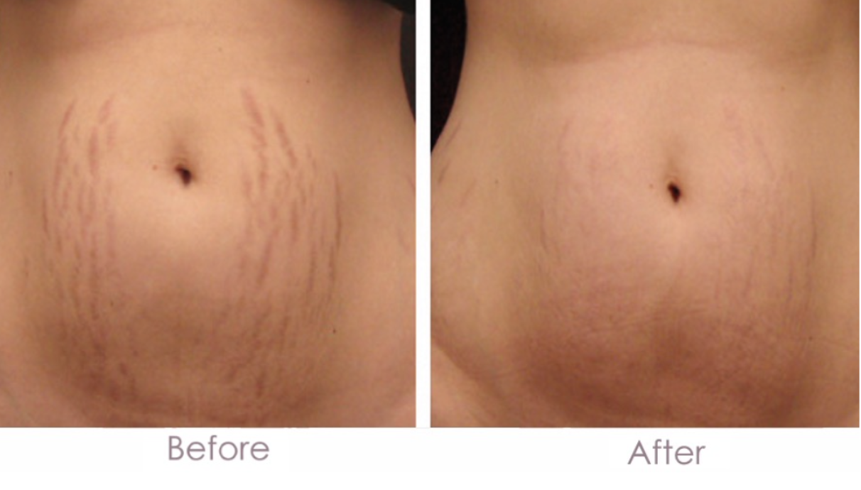 Before and after microneedling showing reduced appearance of abdominal stretch marks after treatment