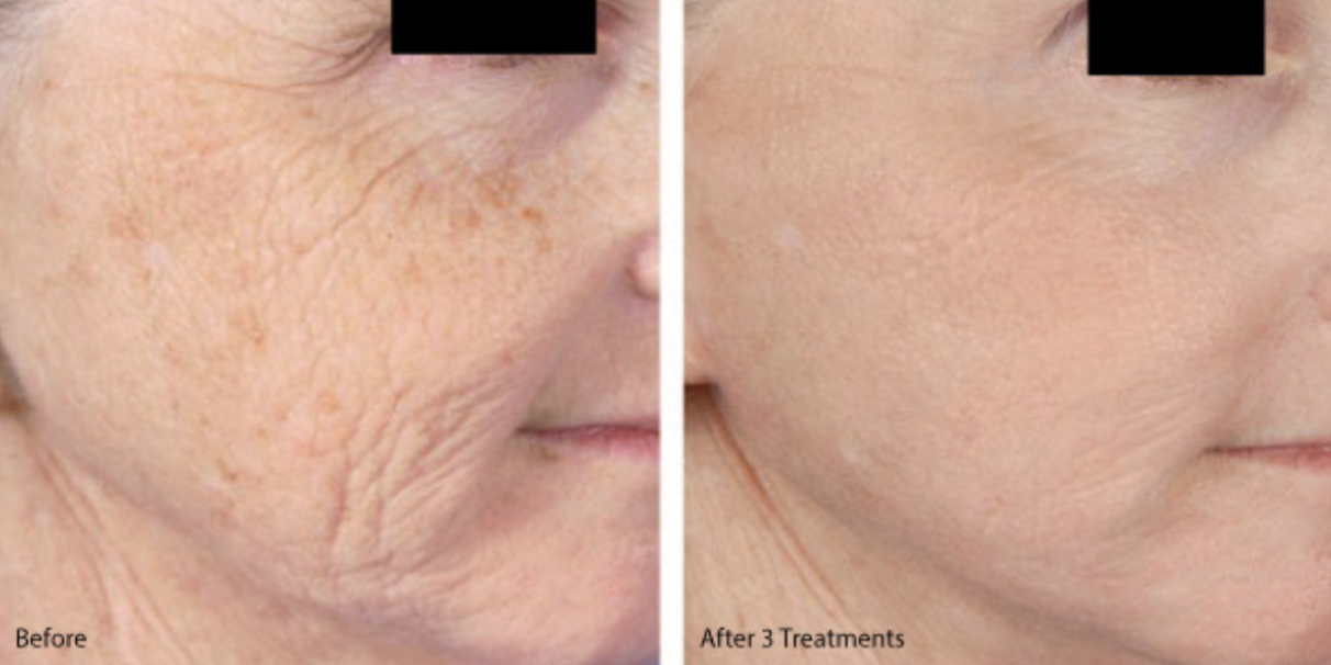 Before and after microneedling showing improved skin texture and reduced fine lines after three treatments