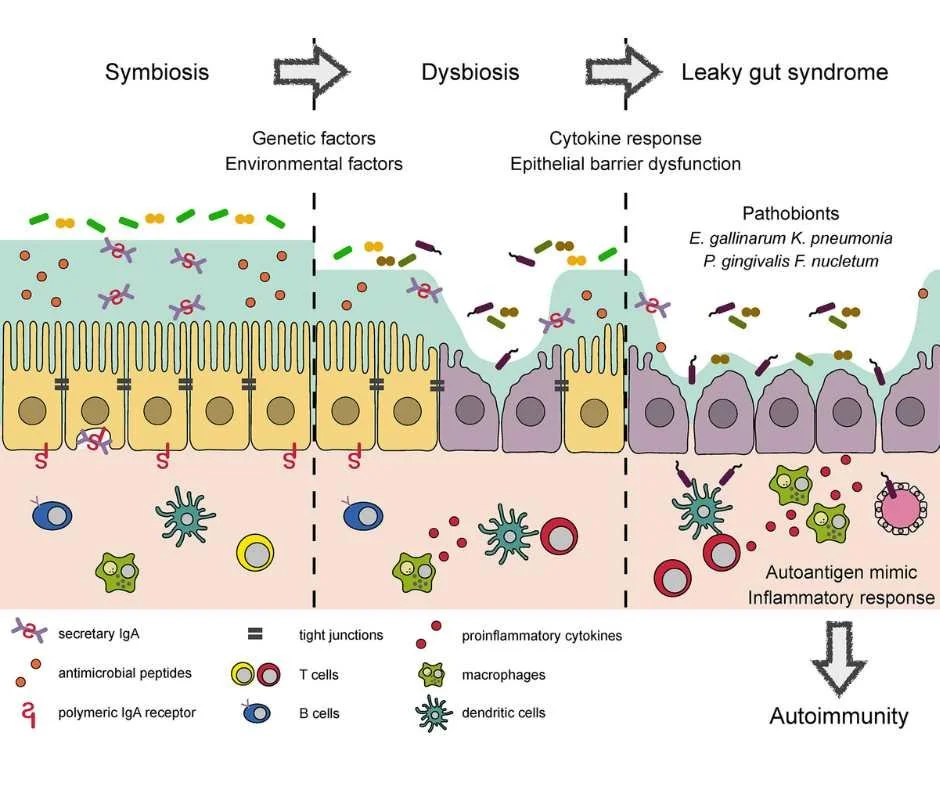 Diagram illustrating the progression from healthy gut symbiosis to dysbiosis and leaky gut syndrome, showing tight junction breakdown, immune activation, inflammation, and autoimmune response
