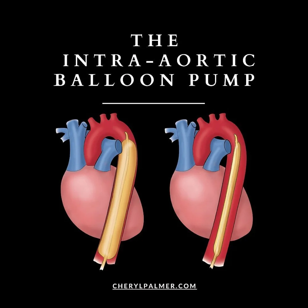 🟥The intra-aortic balloon is a volume displacement device that is positioned inside the aorta between a left subclavian artery and renal arteries.
◾️The usual insertion site is the femoral artery but the balloon may also be inserted via the aortic a