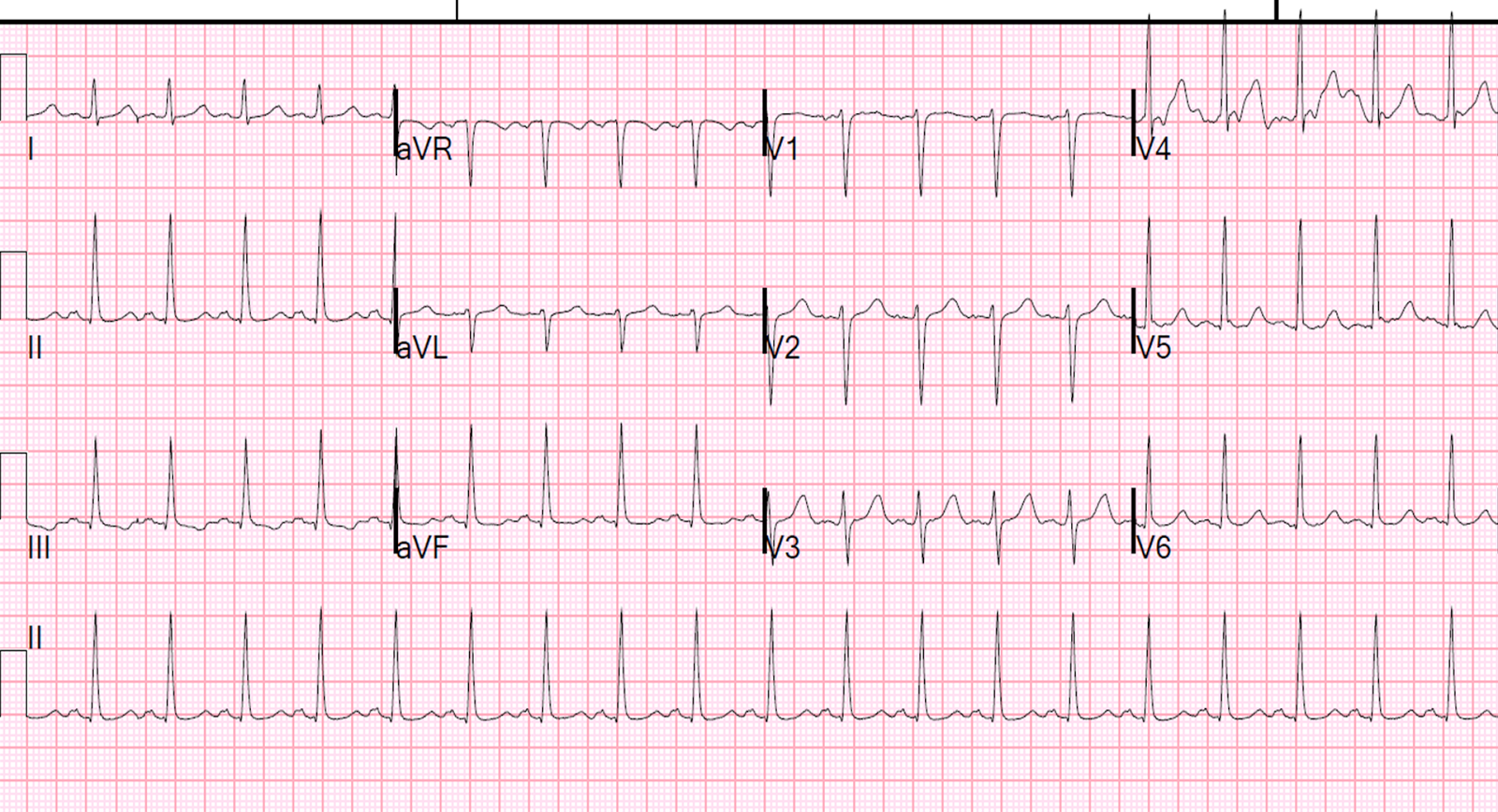 THE LOW VOLTAGE Electrocardiogram (ECG/EKG)