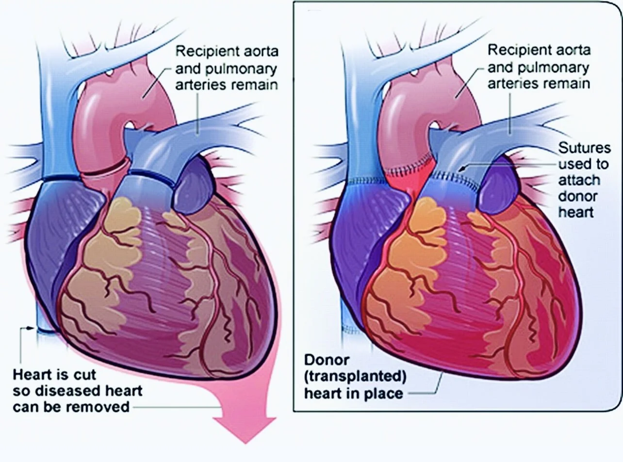 Heart Transplantation