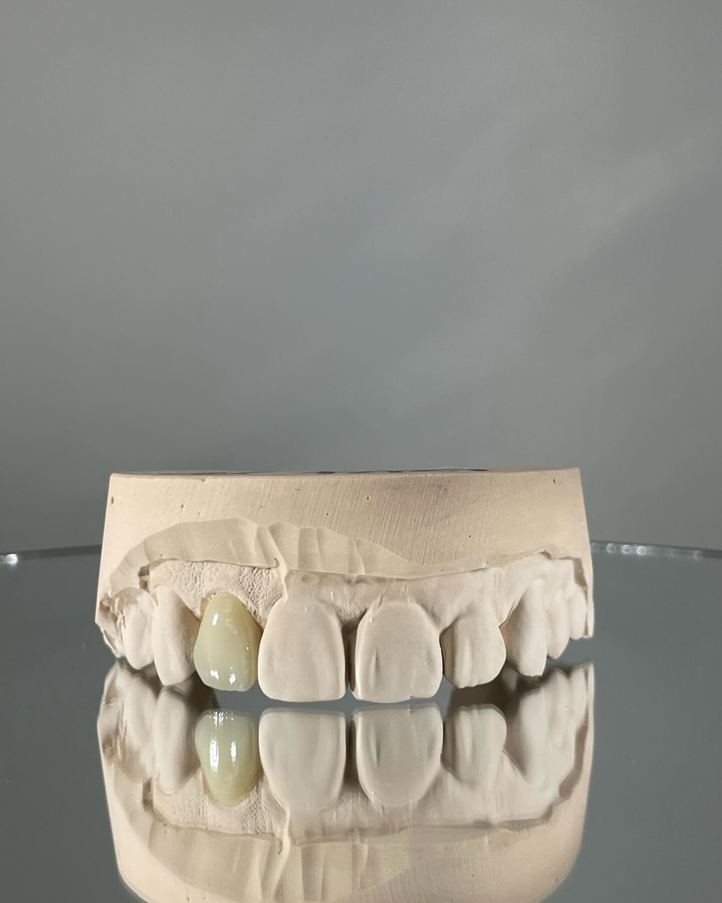 The way this crown matches the anatomy of the natural teeth is perfection✨🦷 Our dental technicians are so talented! 

#dentallab#dental#dentallaboratory#dentaltechnician#fixedprosthodontics#removableprosthodontics#saskatchewandental#saskatchewandent