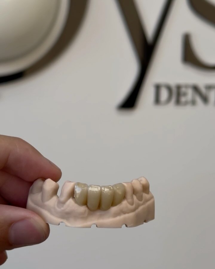 A gorgeous four unit, layered lower anterior bridge ready to match a clients smile🦷✨

#dentallab#dentallaboratory#saskatoondental#saskdental#saskatoondentaltech#dentaltech#dentaltechnician