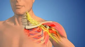Thoracic Outlet Syndrome pic