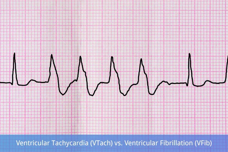 Taquicardia Ventricular Polimórfica: Tratamiento Efectivo