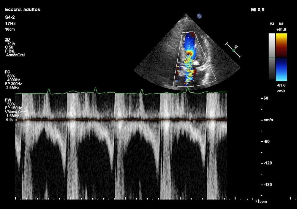 Miocardiopatía: Tipos y Tratamientos Efectivos
