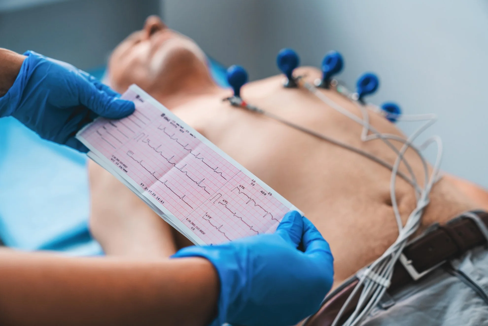 Taquicardia Ventricular Polimorfa: Causas y Tratamiento