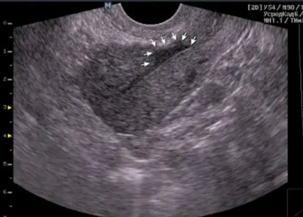Cicatrices en el Corazón: Salud Cardiovascular
