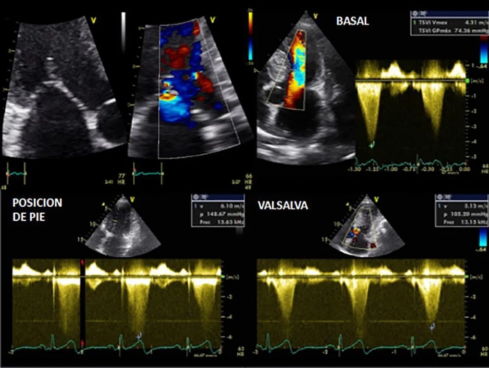 Miocardiopatía Hipertrófica: Infórmate y Actúa