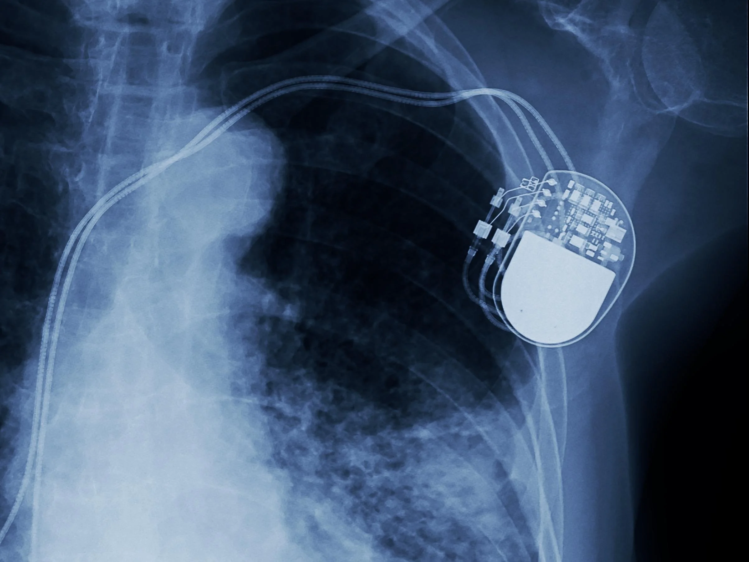 DAI (dispositivo automático implantable): Seguridad Cardiaca Esencial