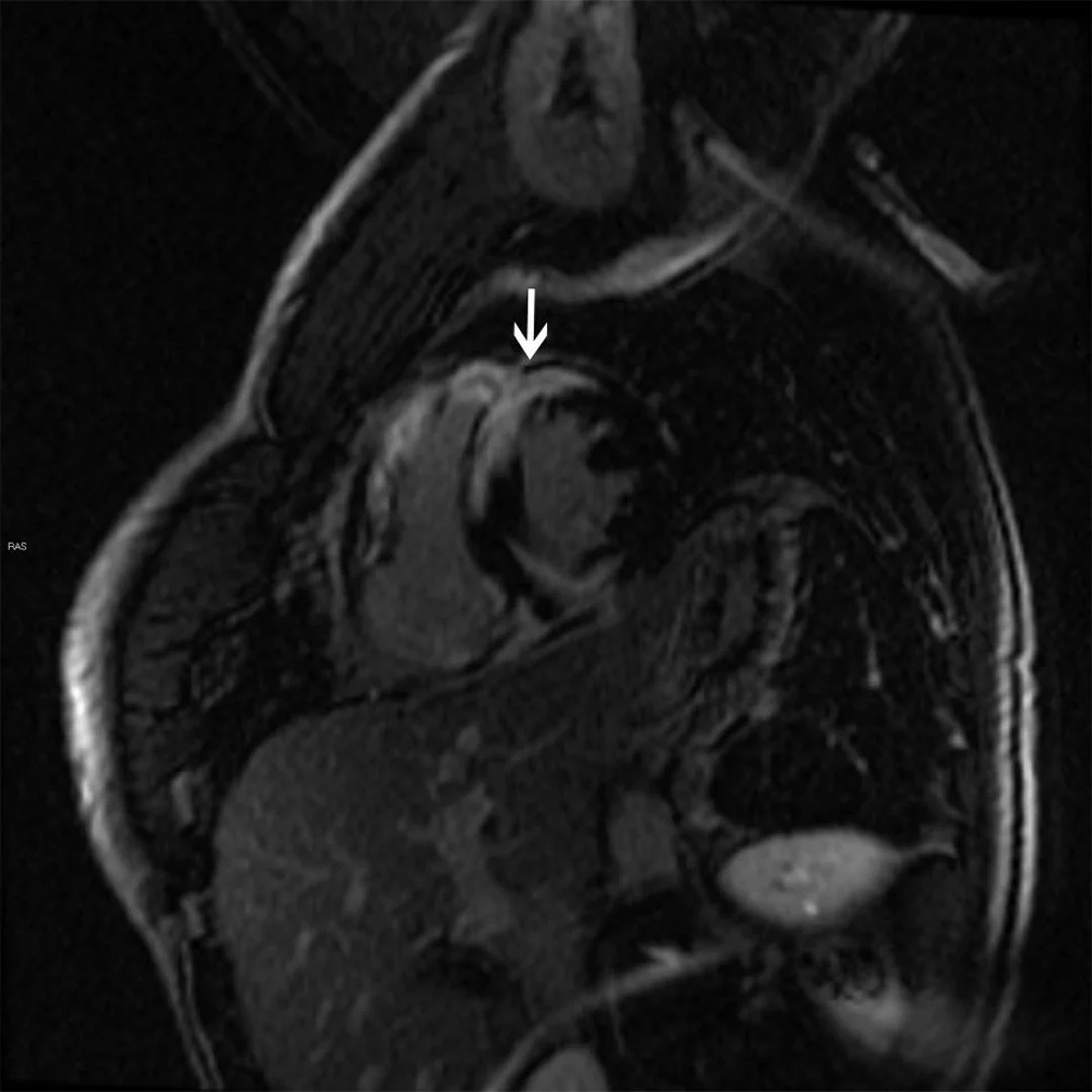 Miocardiopatía Dilatada: Diagnóstico y Tratamiento