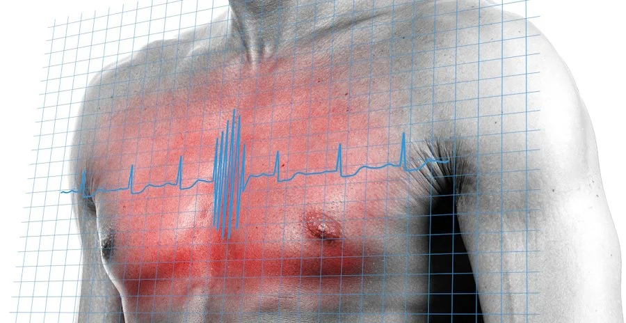 Síndrome de QT Largo ECG: Diagnóstico Efectivo