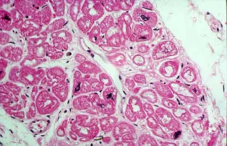 Miocardiopatía Dilatada: Síntomas y Tratamientos