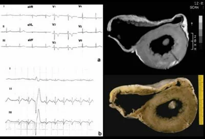 Miocardiopatía Arritmogénica del Ventrículo Derecho: Guía completa