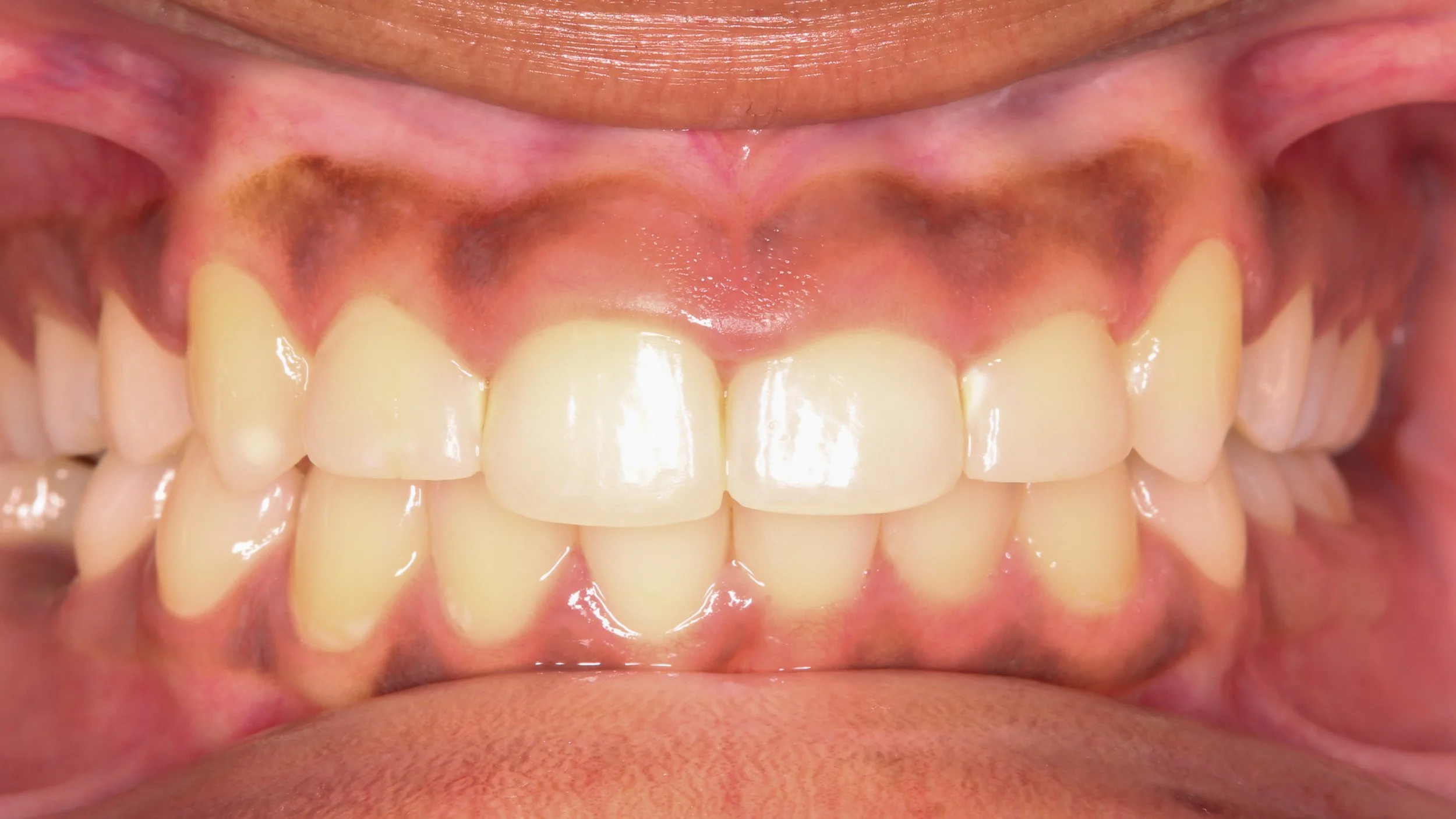 Gum Lift Contouring Athens, GA Watkinsville, GA — Hall Dental