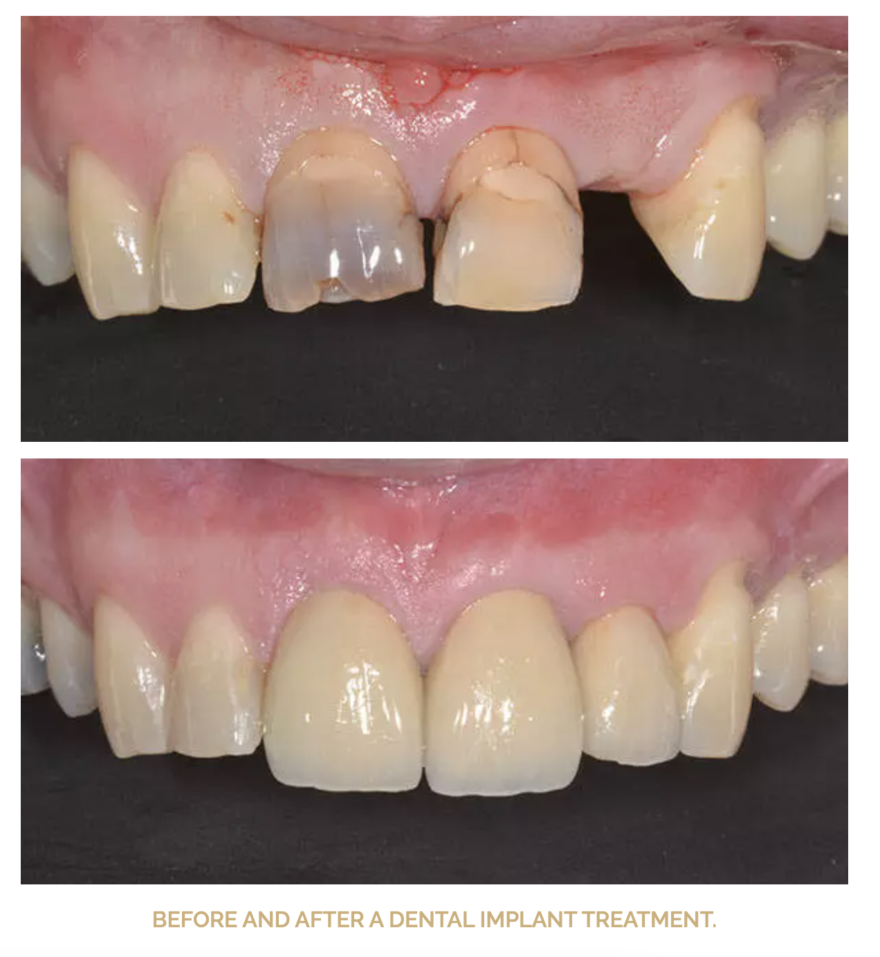 Dental Implants — Hartley Dental Dentist in Plymouth