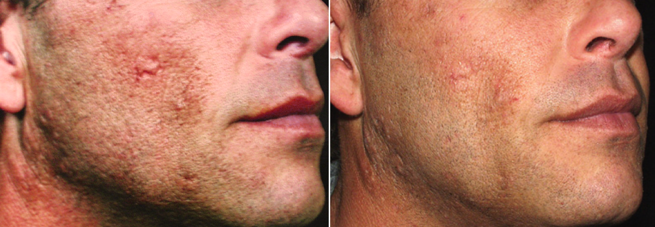 CIT_Face_Texture_BeforeAfter.png