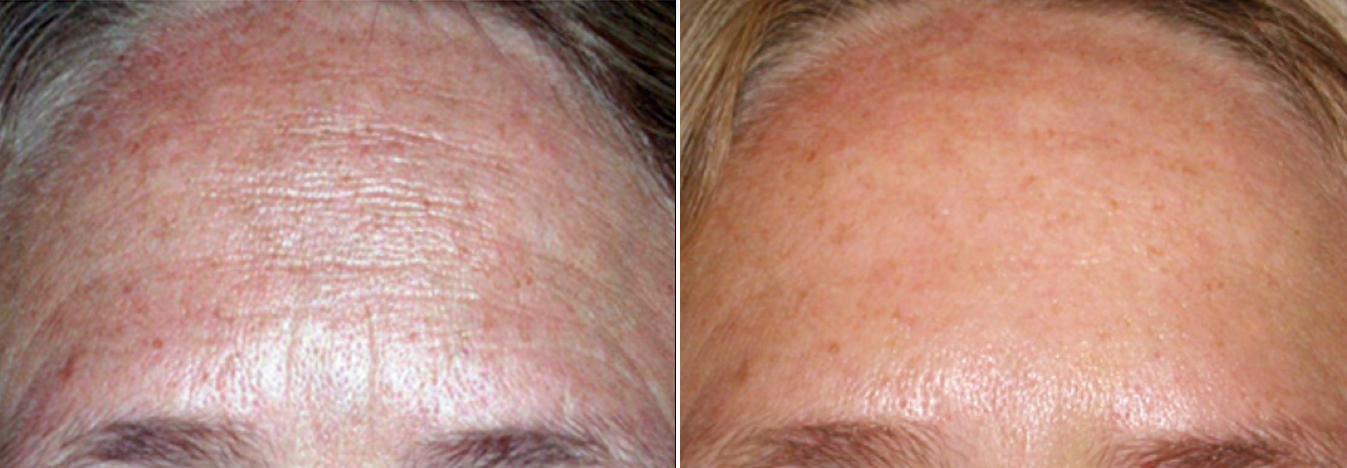 CIT_Face_Forehead_BeforeAfter.png