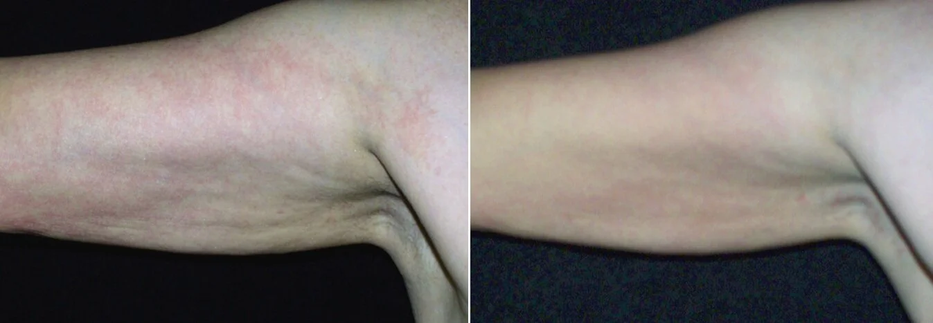 CIT_Arm_Sagging_BeforeAfter.jpg