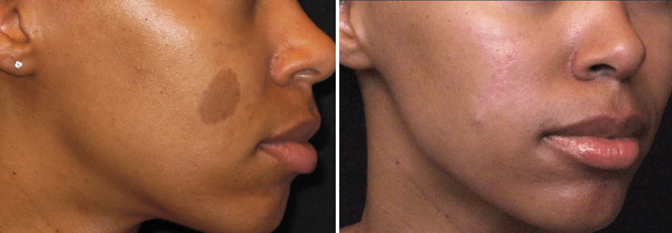 CIT_Dark_Skin_Pigmentation_BeforeAfter.png