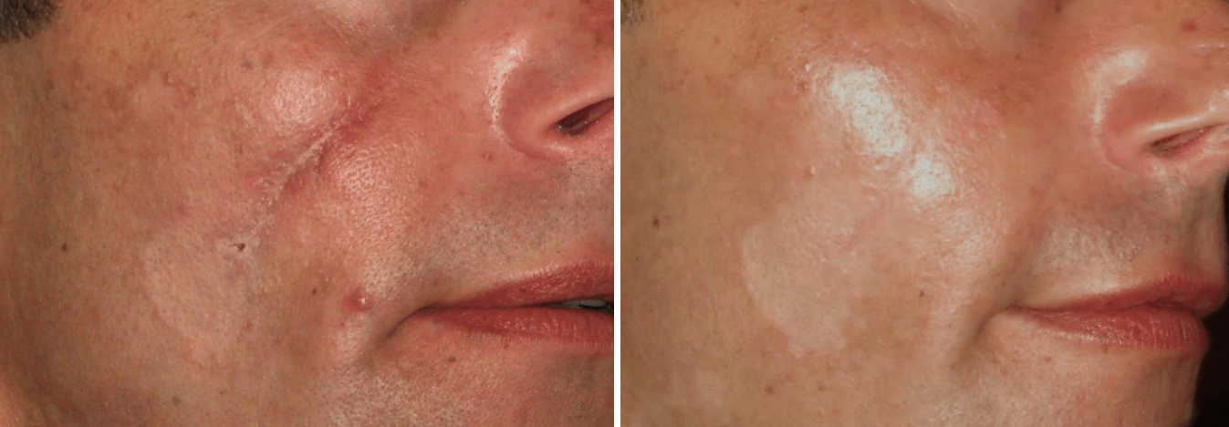 CIT_Scar_Pigmentation_BeforeAfter.png
