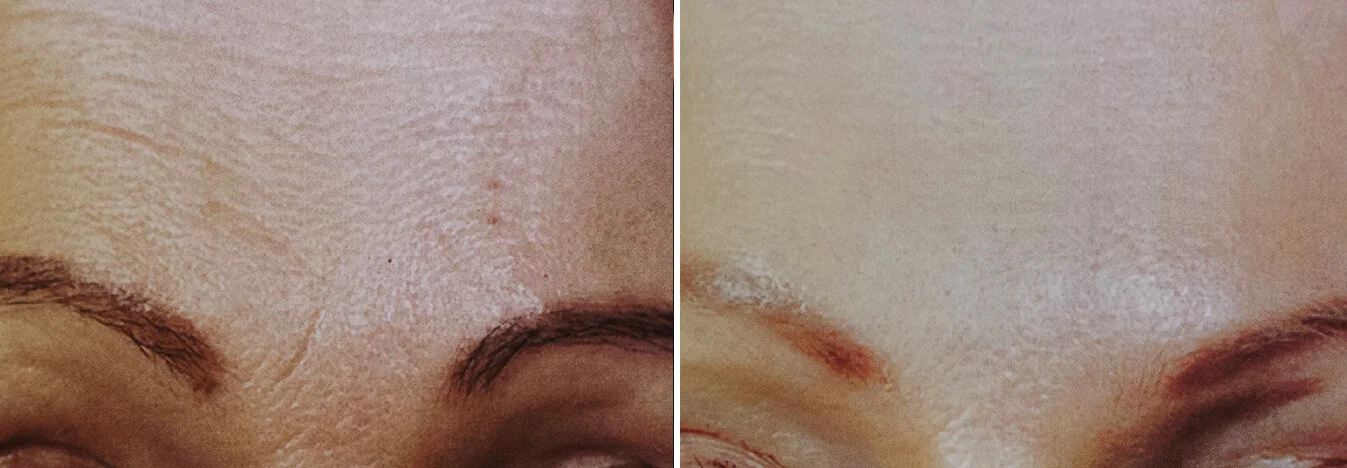 CIT_Forehead_BeforeAfter.jpg
