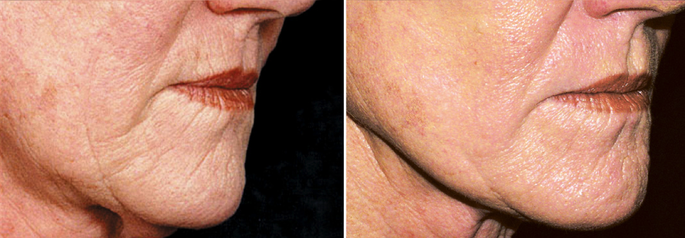 CIT_Face_Texture2_BeforeAfter.png