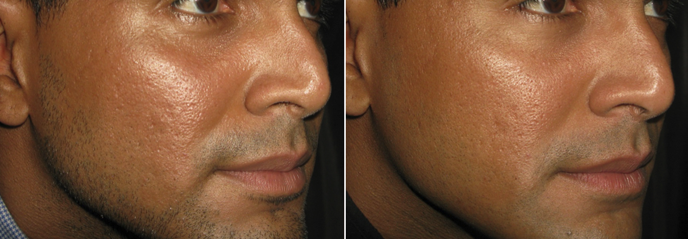 CIT_Face_Acne_Scars_2_BeforeAfter.png