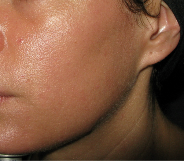 AFTER A SERIES OF 3 TREATMENTS 