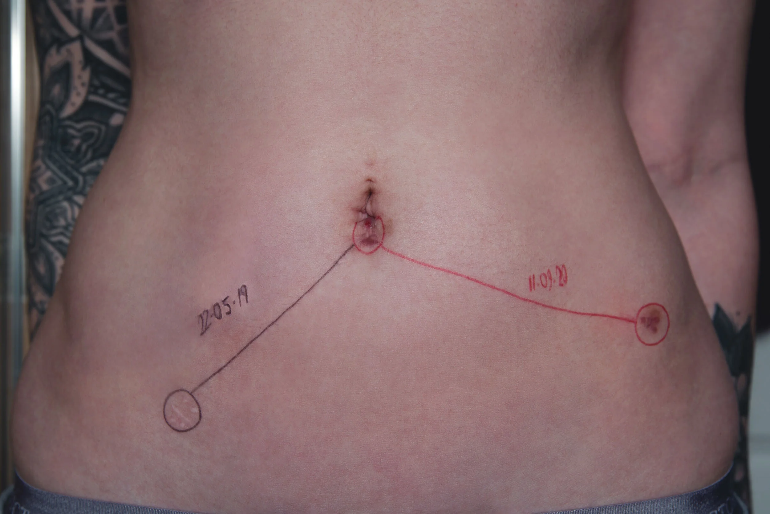 FROM “JUST BAD IBS” AND “ARE YOU SURE YOU’RE NOT JUST STRESSED” TO A LIFELONG CONDITION.