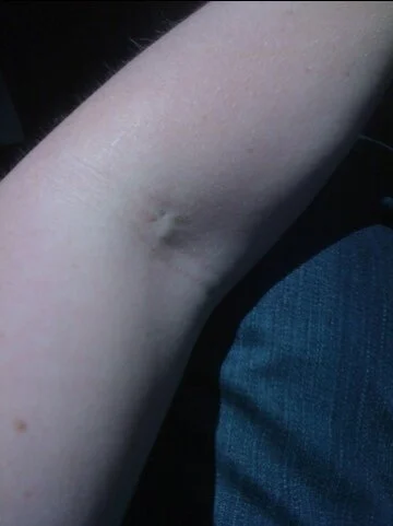 Needle pricks and scar tissue now permanent