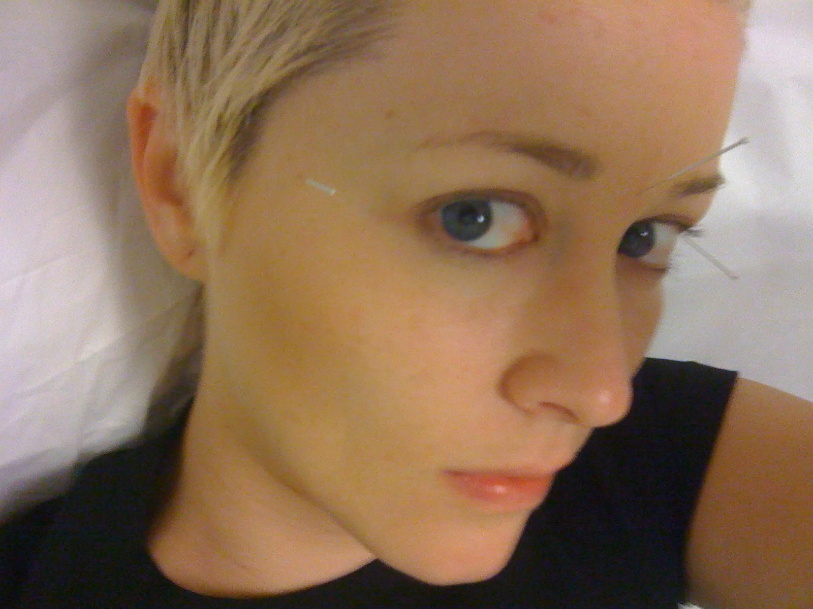 Acupuncture; all the cool kids are doing it